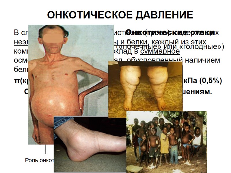 ОНКОТИЧЕСКОЕ ДАВЛЕНИЕ В сложных биологических системах (кровь), содержащих неэлектролиты, электролиты и белки, каждый из ОНКОТИЧЕСКОЕ ДАВЛЕНИЕ В сложных биологических системах (кровь), содержащих неэлектролиты, электролиты и белки, каждый из